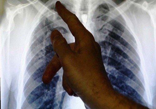 Tuberculosis2