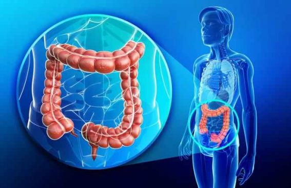 colorectal cancer 567x367