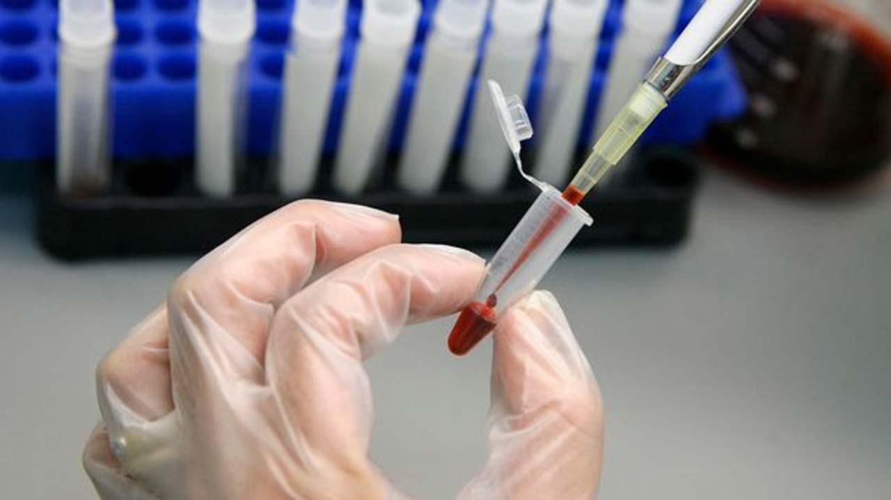 A laboratory technician examines blood samples for HIVAIDS in a public hospital in Valparaiso city