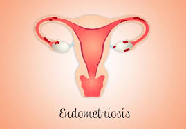 Endometriosis