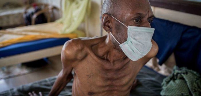 tuberculosis patient male 702x336