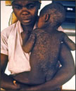 people measles