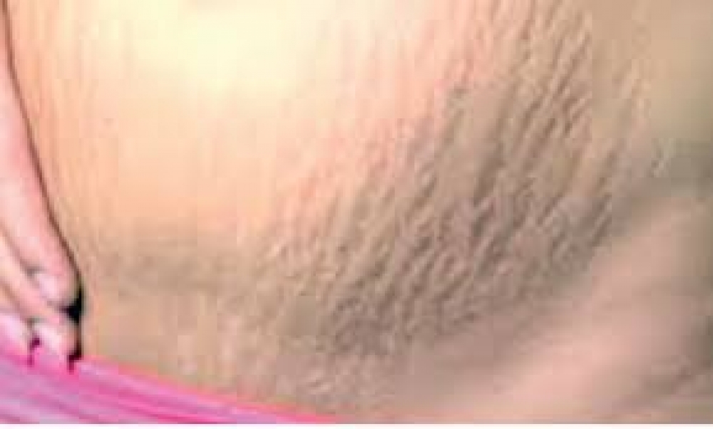 Scratching stomach can’t cause stretch marks in pregnancy –Dermatologists